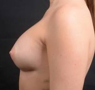 Breast Augmentation Silicone Gel Before & After Gallery - Patient 305347 - Image 4