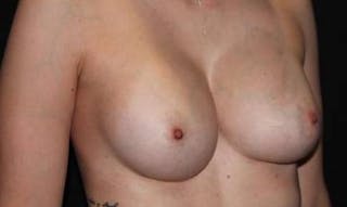 Breast Augmentation Silicone Gel Before & After Gallery - Patient 518909 - Image 4