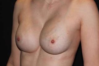 Breast Augmentation Silicone Gel Before & After Gallery - Patient 518909 - Image 6