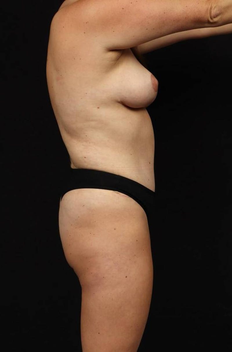 Abdominoplasty Before & After Gallery - Patient 244147 - Image 10