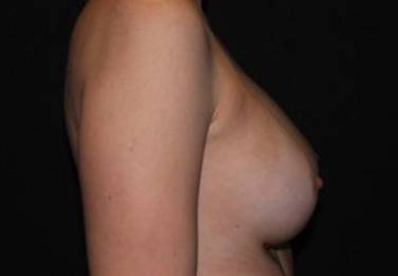 Breast Augmentation Silicone Gel Before & After Gallery - Patient 518909 - Image 8