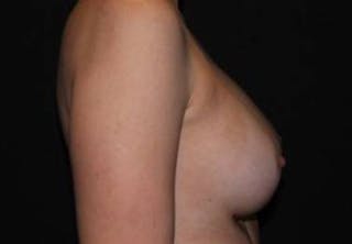 Breast Augmentation Silicone Gel Before & After Gallery - Patient 518909 - Image 8