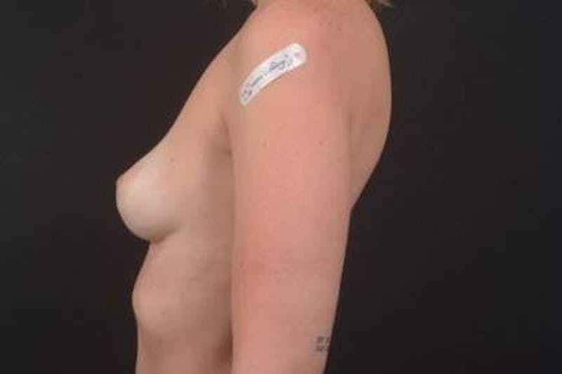 Breast Augmentation Silicone Gel Before & After Gallery - Patient 518909 - Image 9