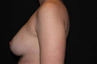 Breast Augmentation Silicone Gel Before & After Gallery - Patient 518909 - Image 10