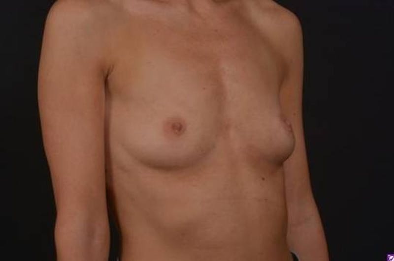 Breast Augmentation Silicone Gel Before & After Gallery - Patient 151360 - Image 7