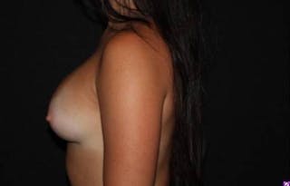 Breast Augmentation Silicone Gel Before & After Gallery - Patient 362091 - Image 6