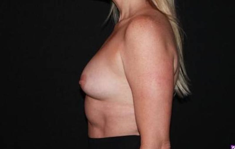 Breast Augmentation Silicone Gel Before & After Gallery - Patient 334426 - Image 5