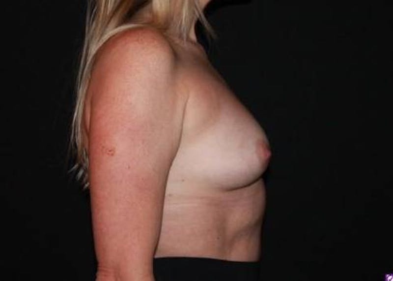 Breast Augmentation Silicone Gel Before & After Gallery - Patient 334426 - Image 9