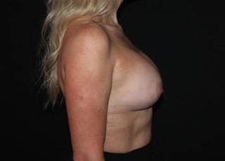 Breast Augmentation Silicone Gel Before & After Gallery - Patient 334426 - Image 10