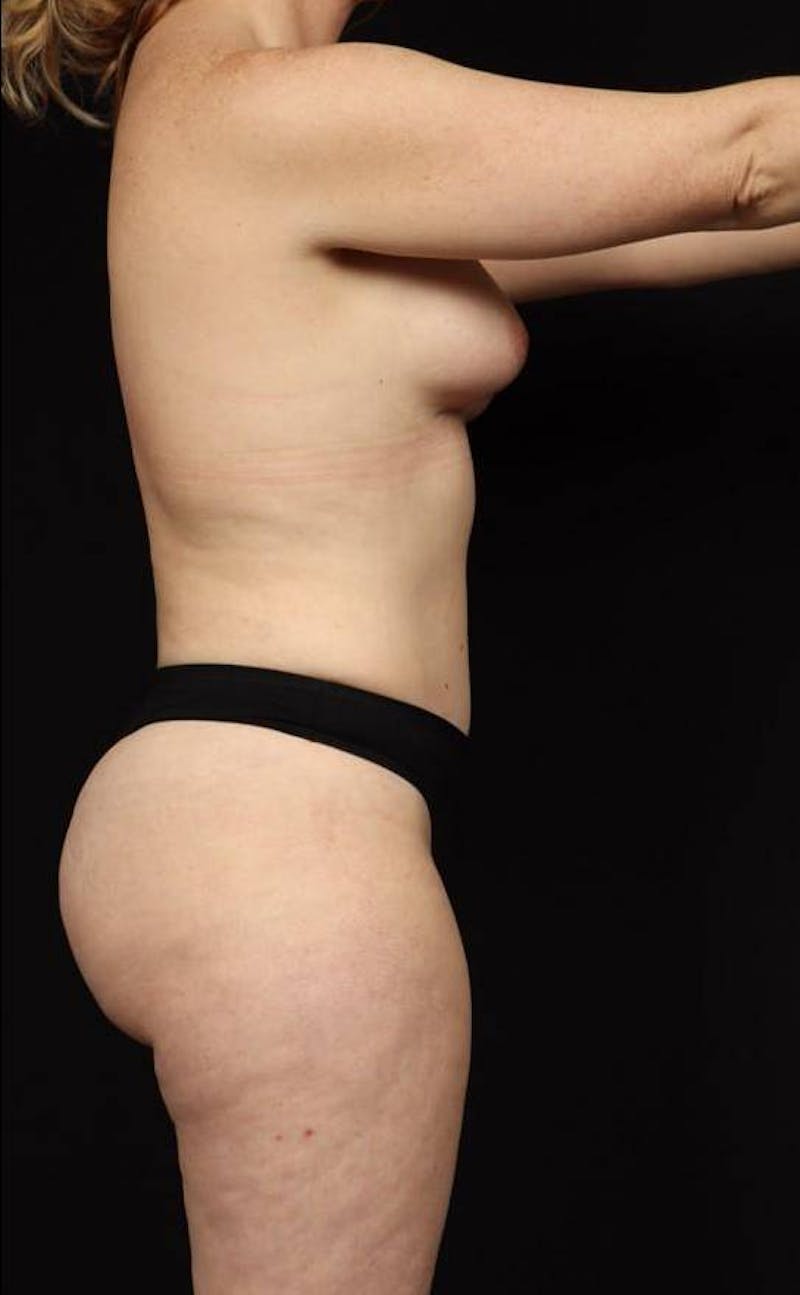 Breast Augmentation Silicone Gel Before & After Gallery - Patient 619540 - Image 10