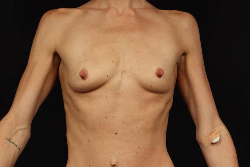 Breast Augmentation Silicone Gel Before & After Gallery - Patient 271369 - Image 1