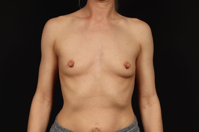 Breast Augmentation Silicone Gel Before & After Gallery - Patient 335225 - Image 1