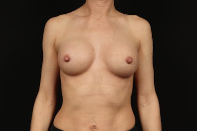 Breast Augmentation Silicone Gel Before & After Gallery - Patient 335225 - Image 2