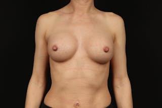 Breast Augmentation Silicone Gel Before & After Gallery - Patient 335225 - Image 2