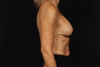 Aesthetic Breast Revision Before & After Gallery - Patient 412931 - Image 10