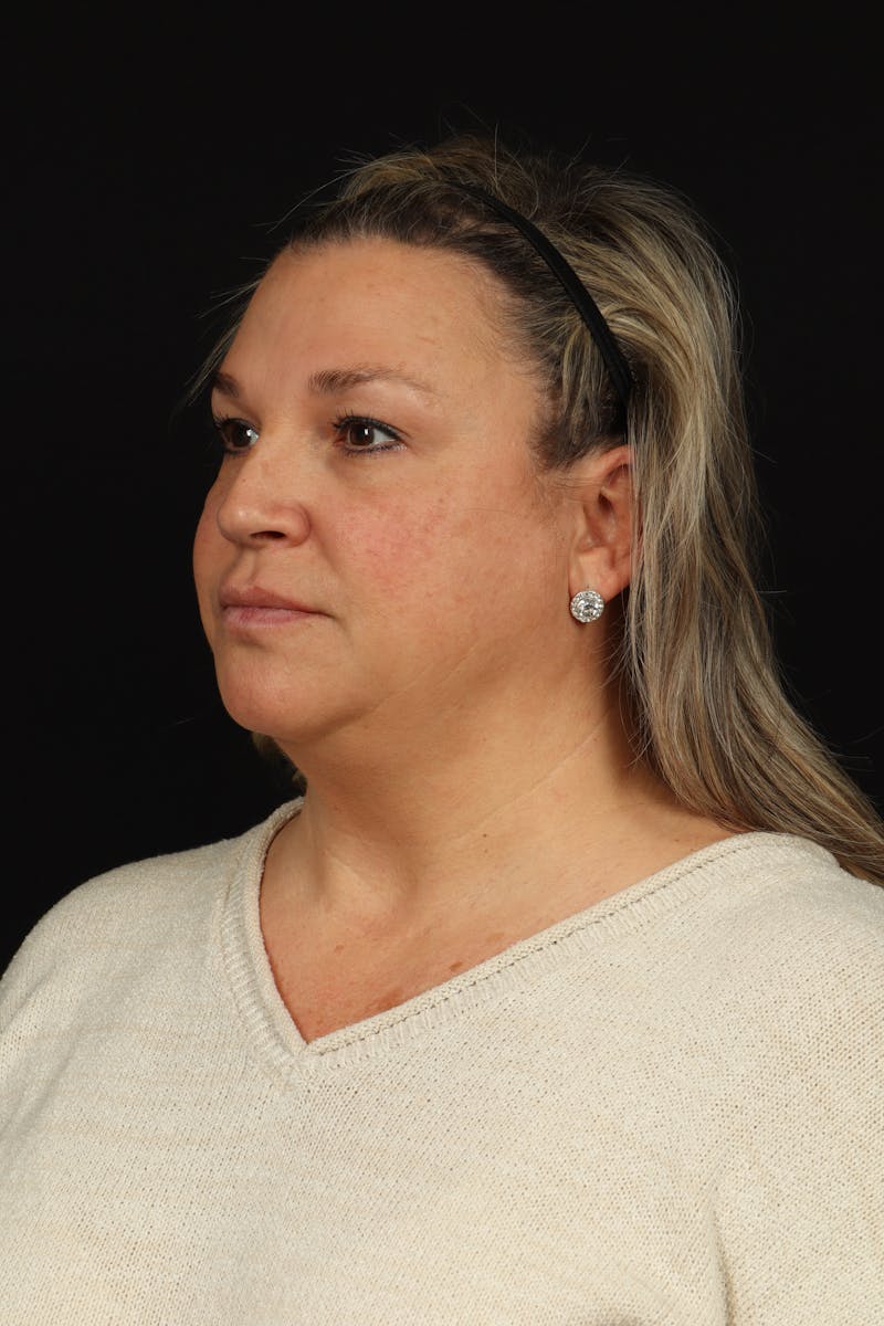 Facelift Before & After Gallery - Patient 449624 - Image 3