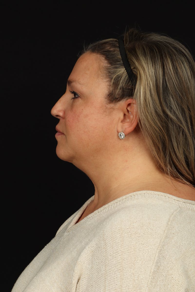 Facelift Before & After Gallery - Patient 449624 - Image 5