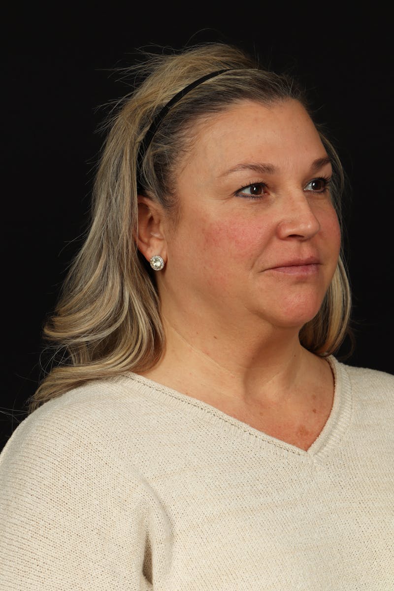 Facelift Before & After Gallery - Patient 449624 - Image 7