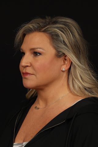 Facelift Before & After Gallery - Patient 449624 - Image 4