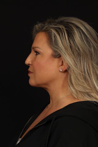 Facelift Before & After Gallery - Patient 449624 - Image 6