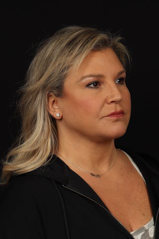 Facelift Before & After Gallery - Patient 449624 - Image 8