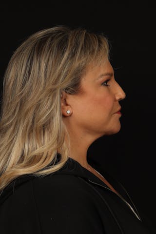 Facelift Before & After Gallery - Patient 449624 - Image 10