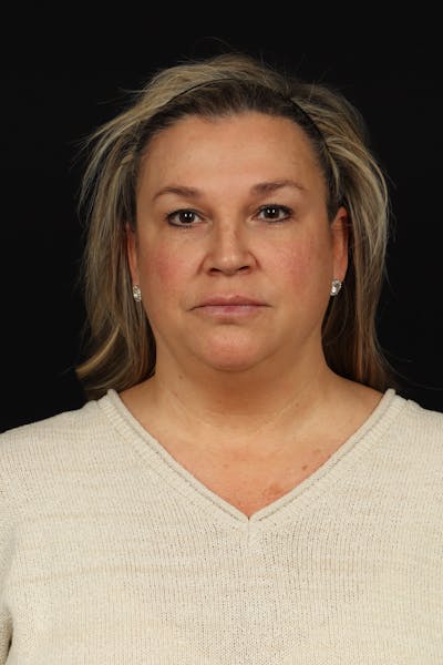 Facelift Before & After Gallery - Patient 449624 - Image 1