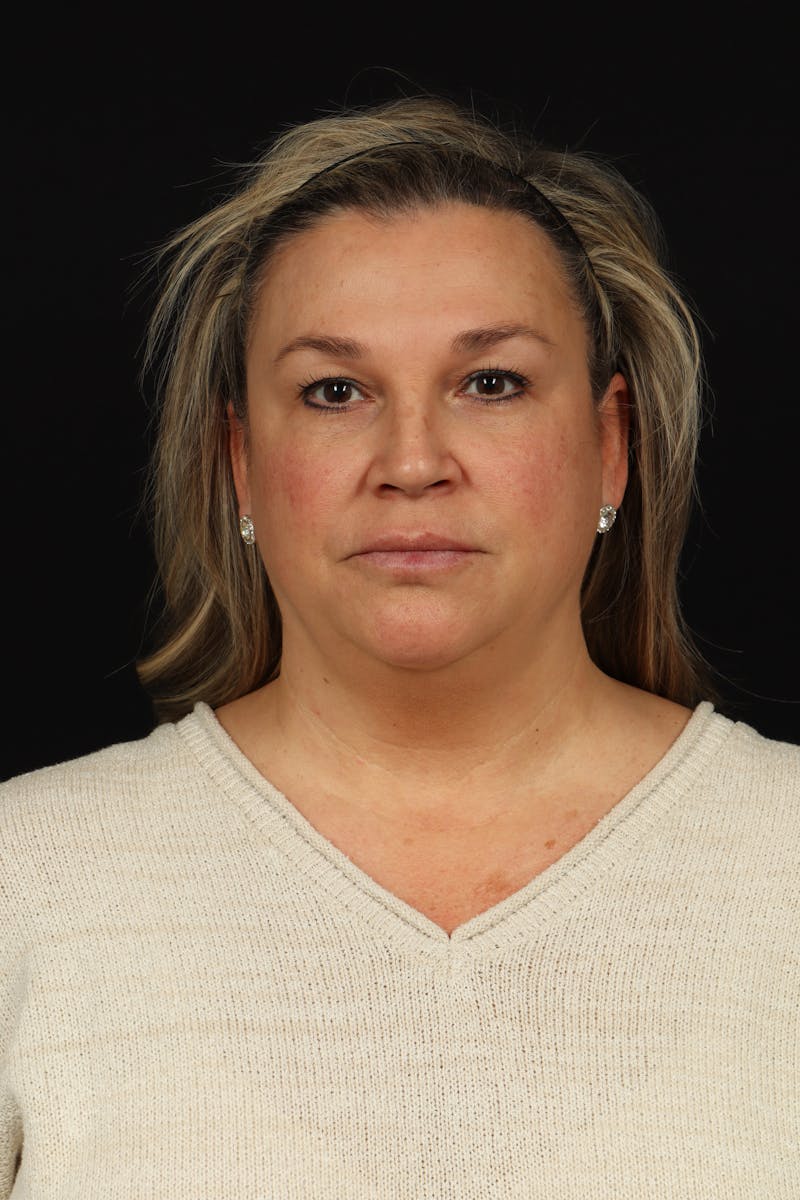 Facelift Before & After Gallery - Patient 449624 - Image 1
