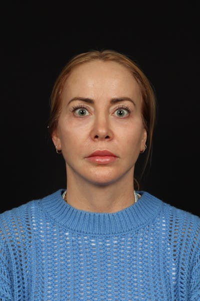Facelift Before & After Gallery - Patient 342284 - Image 2