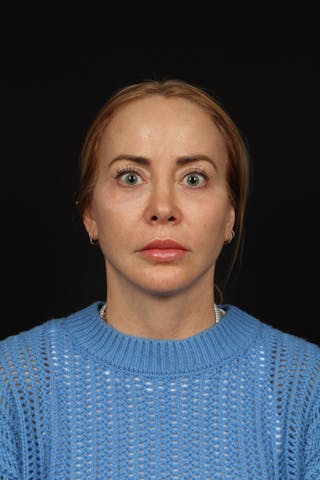 Facelift Before & After Gallery - Patient 342284 - Image 2