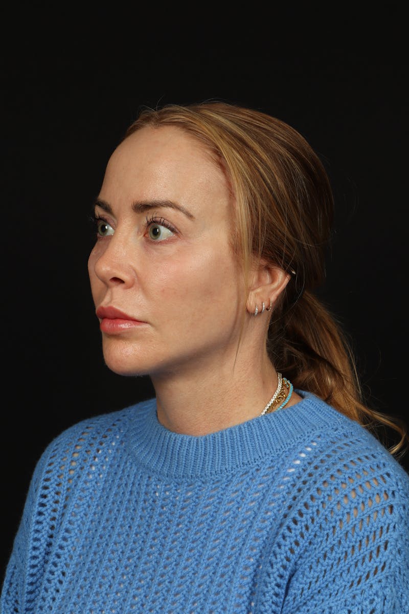Facelift Before & After Gallery - Patient 342284 - Image 4