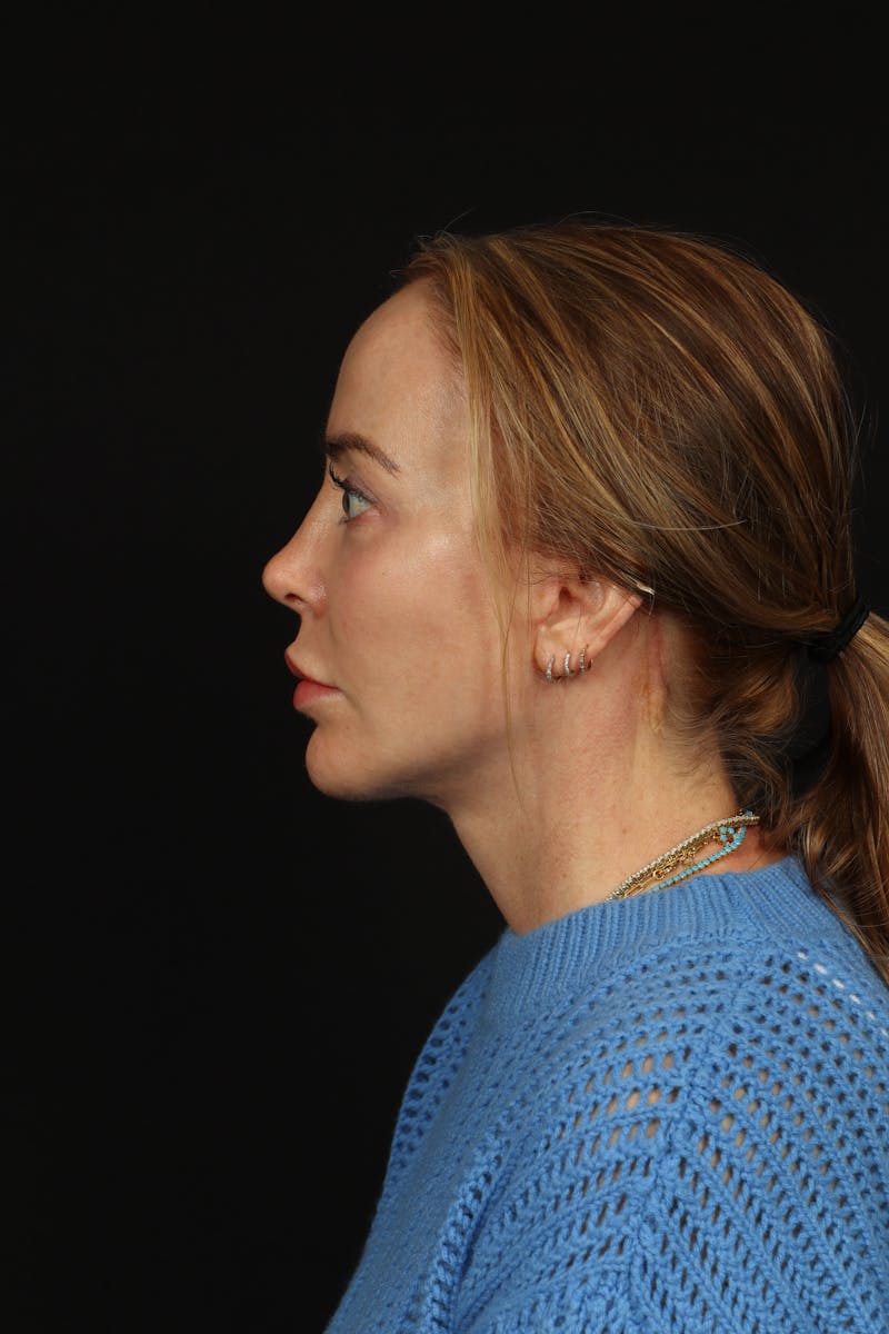 Facelift Before & After Gallery - Patient 342284 - Image 6