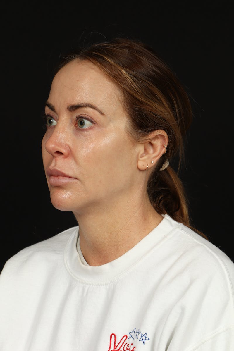 Facelift Before & After Gallery - Patient 342284 - Image 3