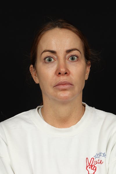 Facelift Before & After Gallery - Patient 342284 - Image 1