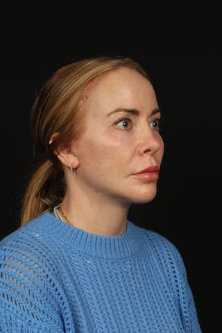 Facelift Before & After Gallery - Patient 342284 - Image 8