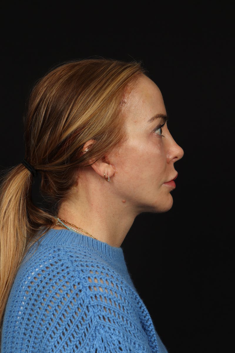 Facelift Before & After Gallery - Patient 342284 - Image 10