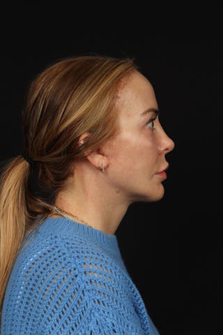 Facelift Before & After Gallery - Patient 342284 - Image 10