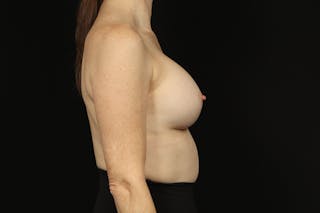 Aesthetic Breast Revision Before & After Gallery - Patient 180366 - Image 10