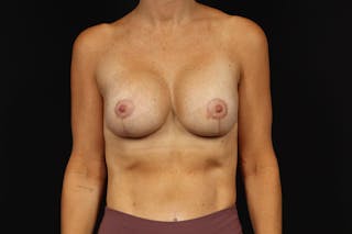 Breast Augmentation Mastopexy Before & After Gallery - Patient 217255 - Image 2