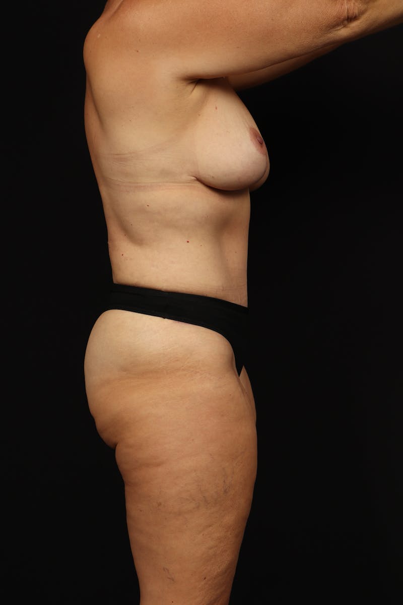 Mommy Makeover Before & After Gallery - Patient 371302 - Image 10