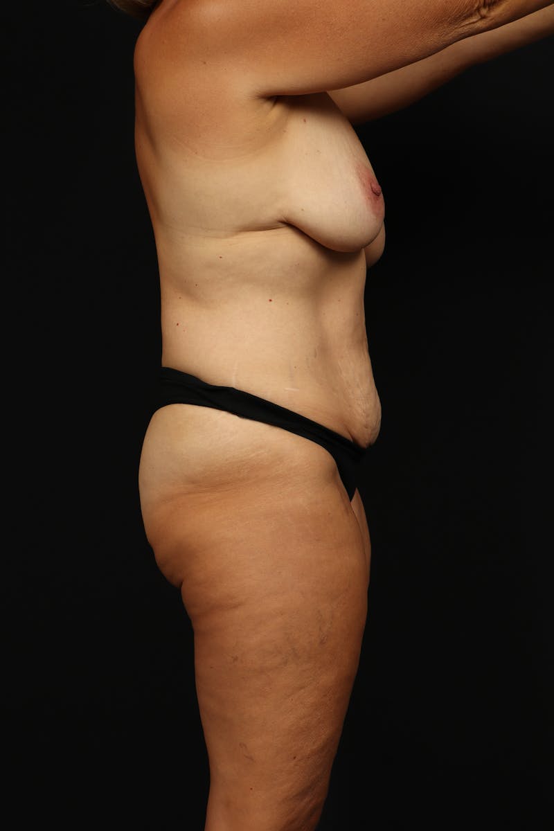 Mommy Makeover Before & After Gallery - Patient 371302 - Image 9