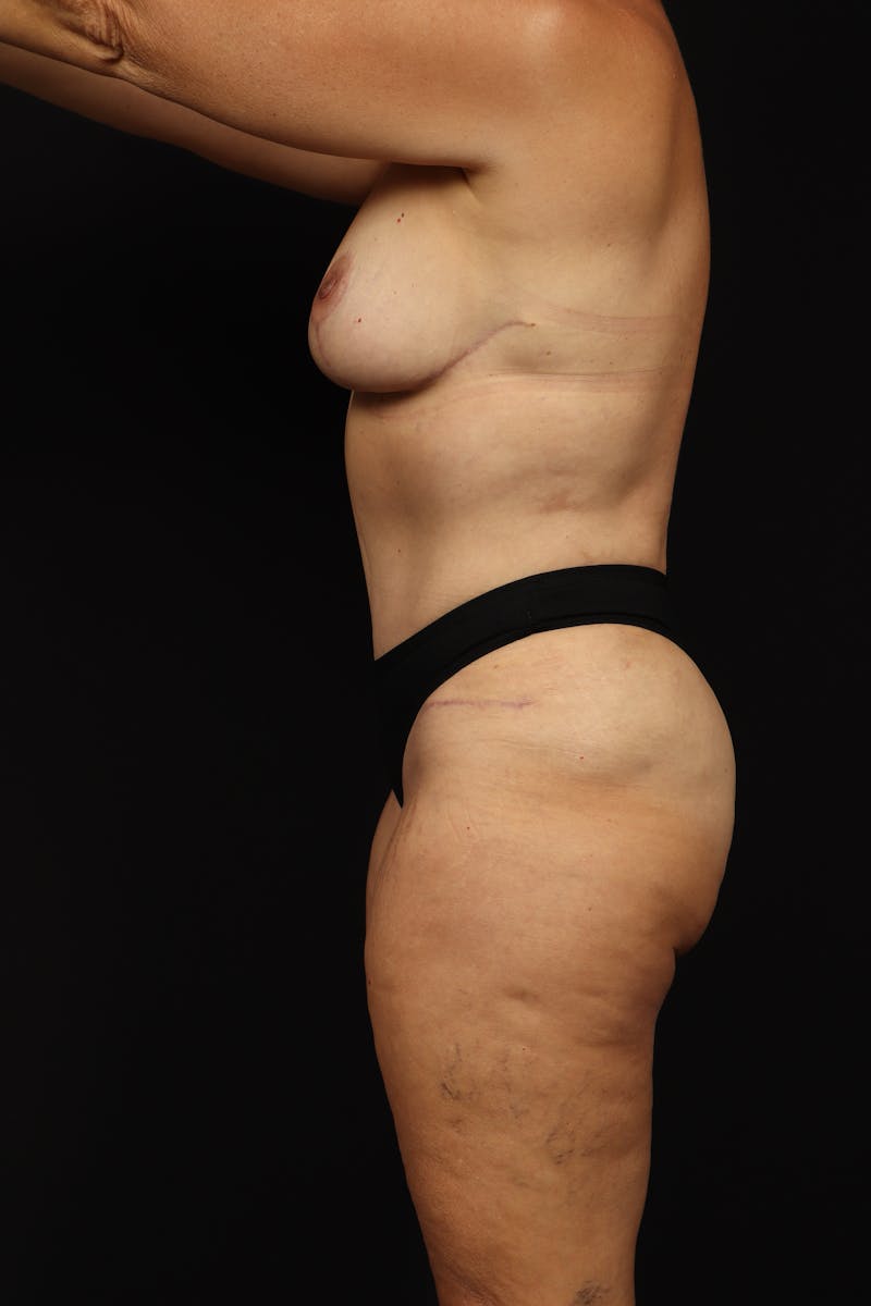 Mommy Makeover Before & After Gallery - Patient 371302 - Image 6
