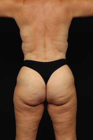 Mommy Makeover Before & After Gallery - Patient 371302 - Image 12