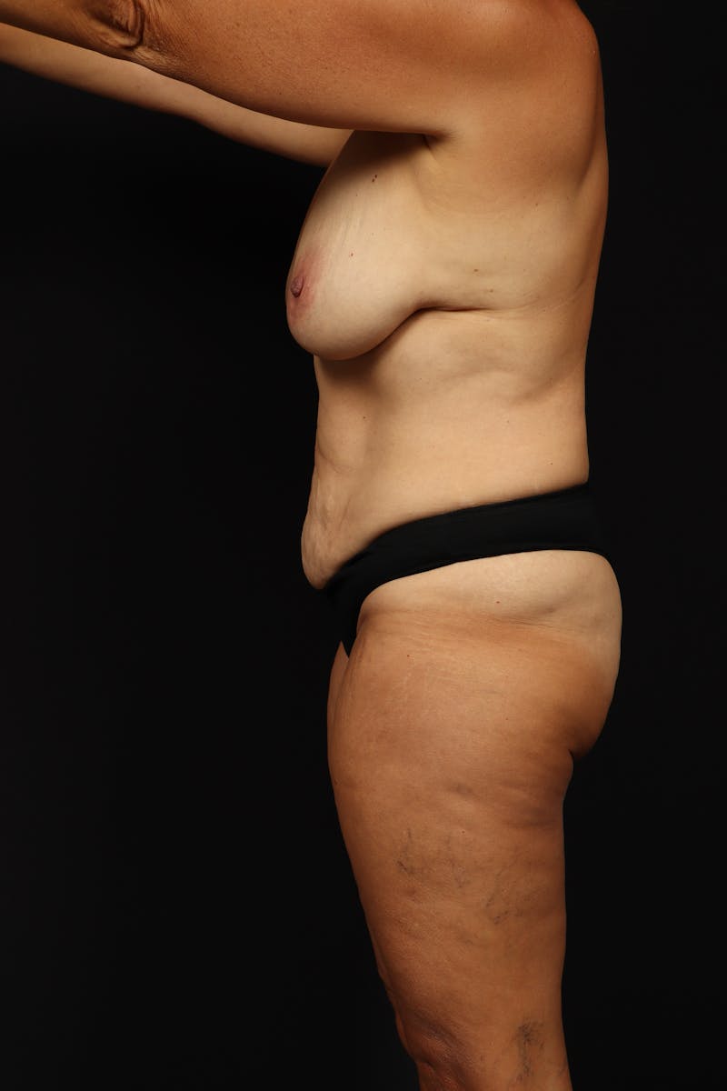 Mommy Makeover Before & After Gallery - Patient 371302 - Image 5