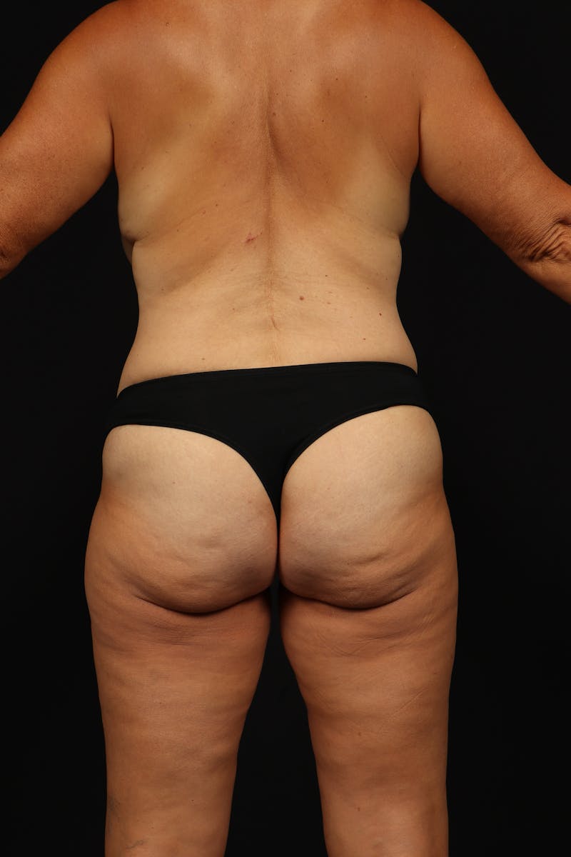 Mommy Makeover Before & After Gallery - Patient 371302 - Image 11