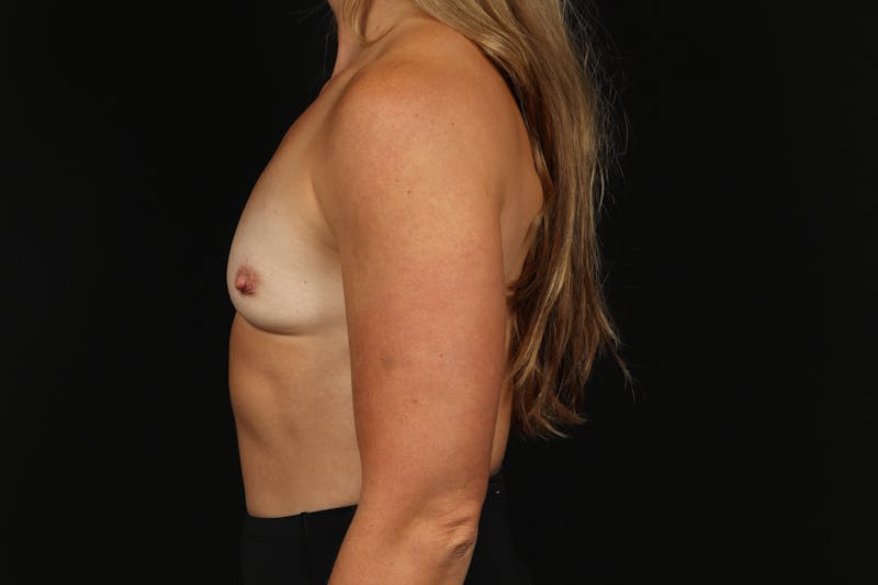 Breast Augmentation Silicone Gel Before & After Gallery - Patient 250211 - Image 5