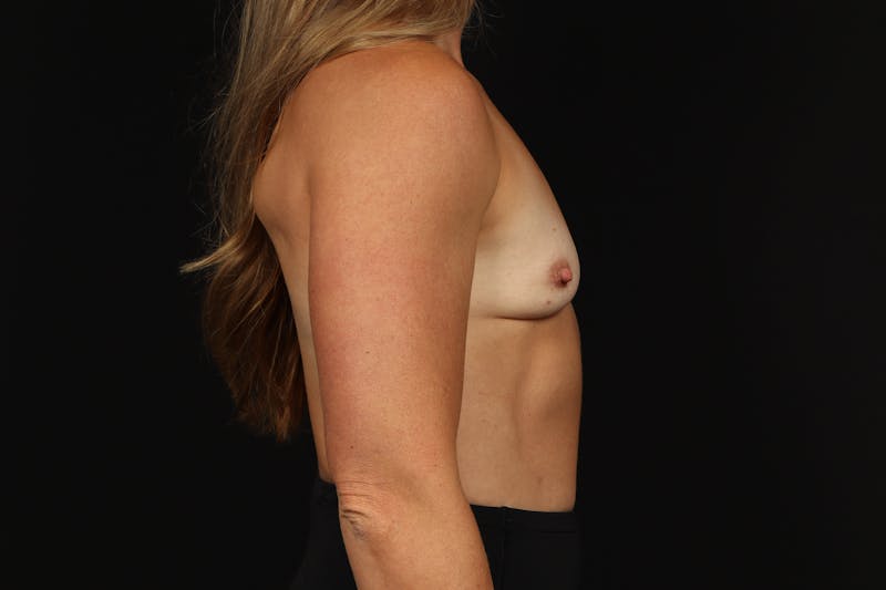 Breast Augmentation Silicone Gel Before & After Gallery - Patient 250211 - Image 9