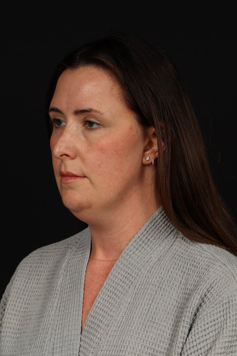 FaceTite Before & After Gallery - Patient 397122 - Image 3