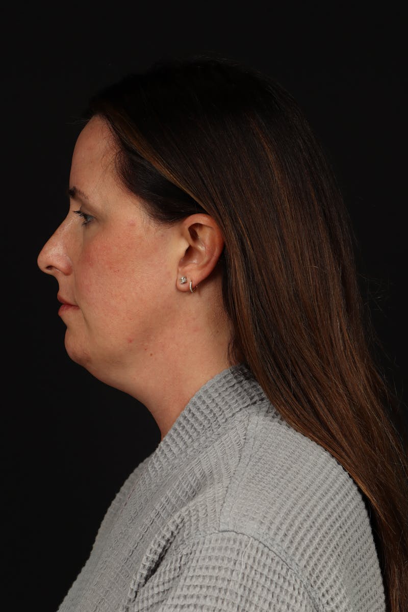 FaceTite Before & After Gallery - Patient 397122 - Image 5