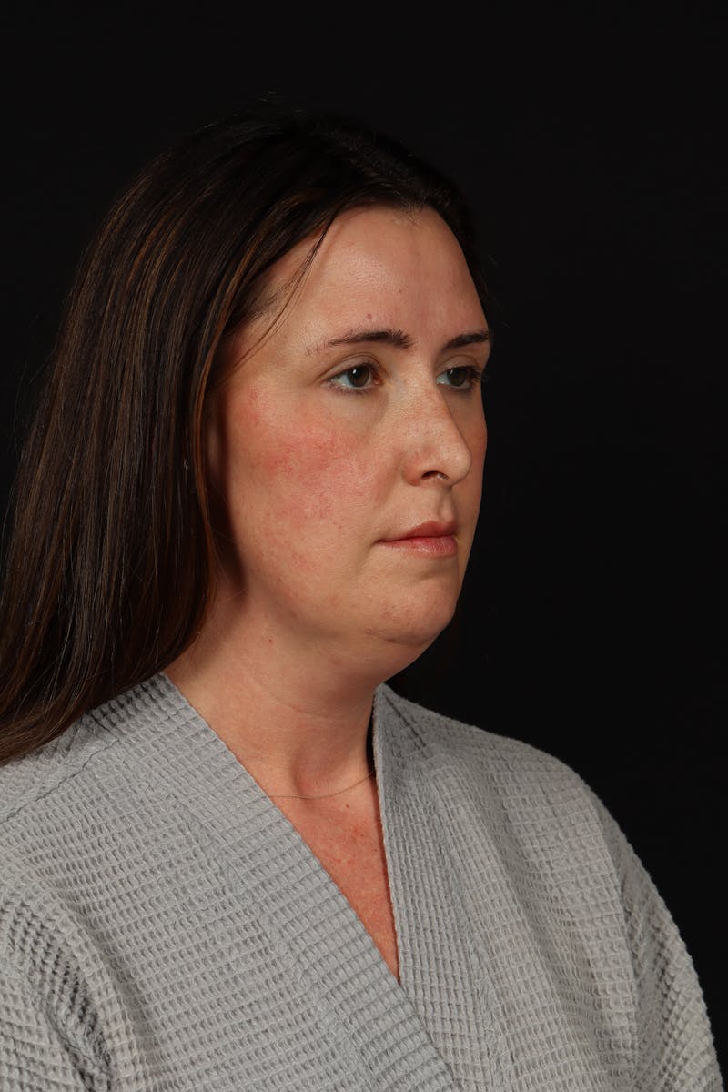 FaceTite Before & After Gallery - Patient 397122 - Image 7